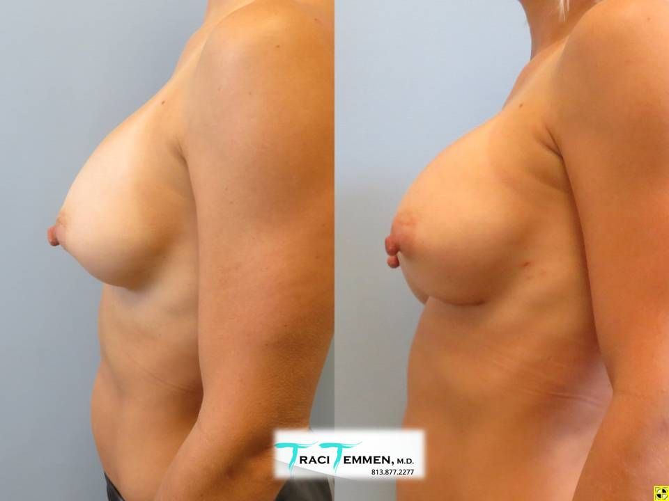 Breast Augmentation Revision Before & After