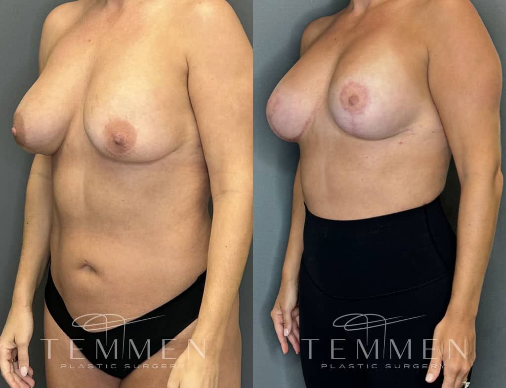 Breast Augmentation Revision Before & After