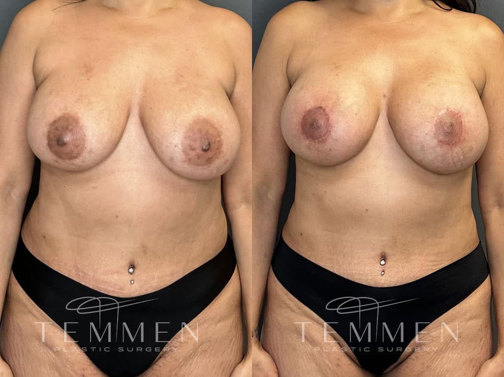 Breast Augmentation Revision Before & After