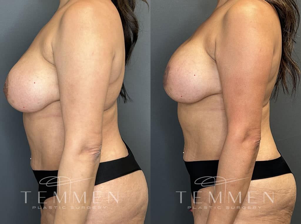 Breast Augmentation Revision Before & After