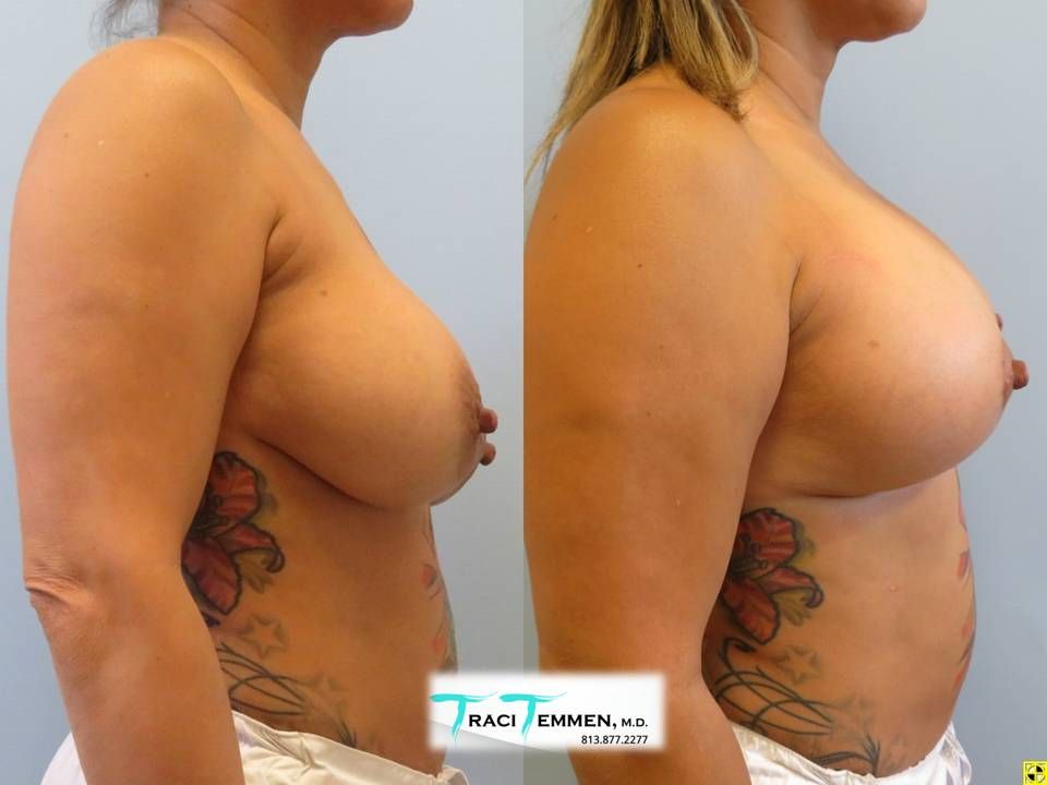 Breast Augmentation Revision Before & After