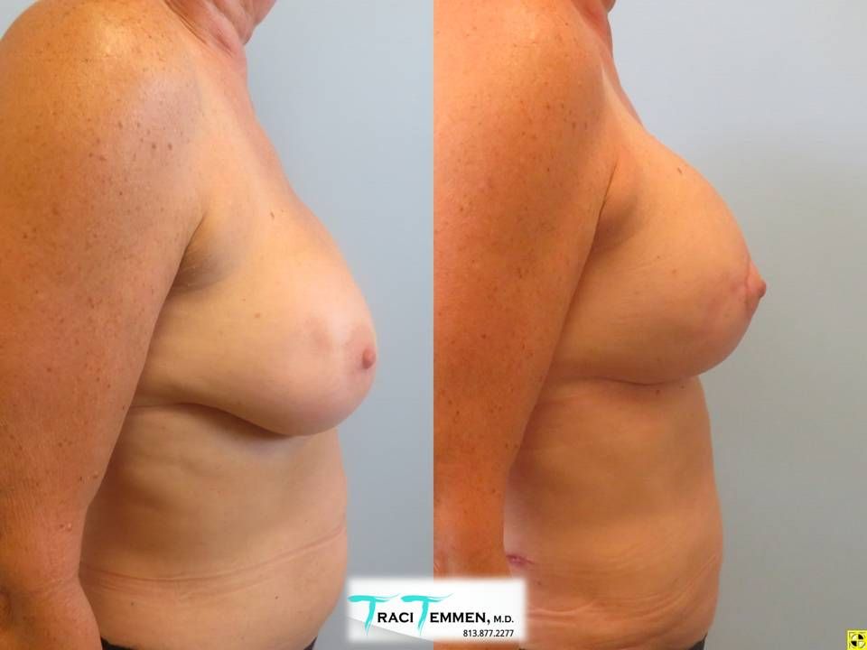 Breast Augmentation Revision Before & After