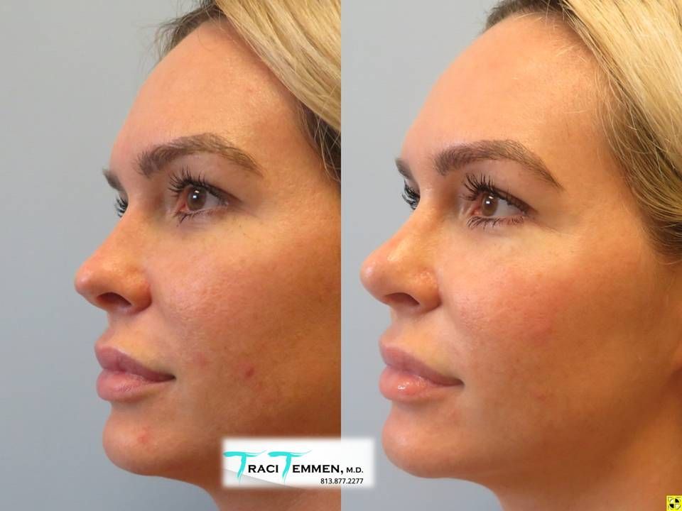 Rhinoplasty Before & After