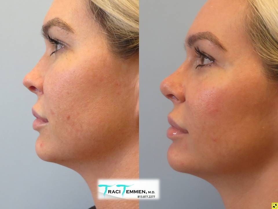 Rhinoplasty Before & After
