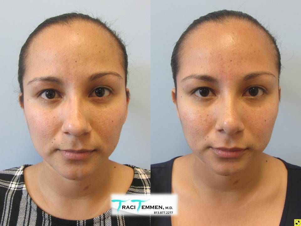 Rhinoplasty Before & After