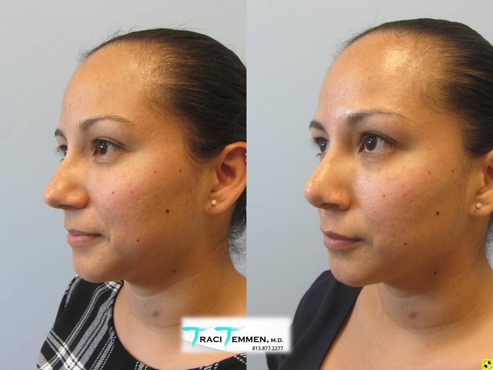 Rhinoplasty Before & After