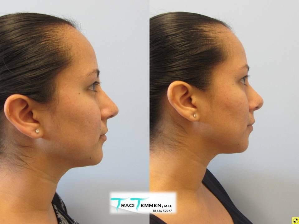 Rhinoplasty Before & After