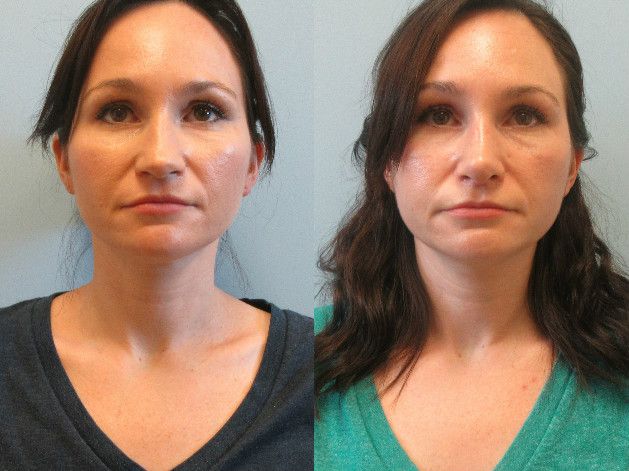 Rhinoplasty Before & After