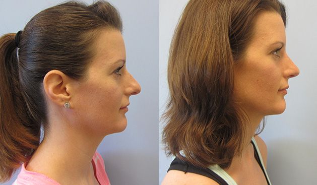 Rhinoplasty Before & After