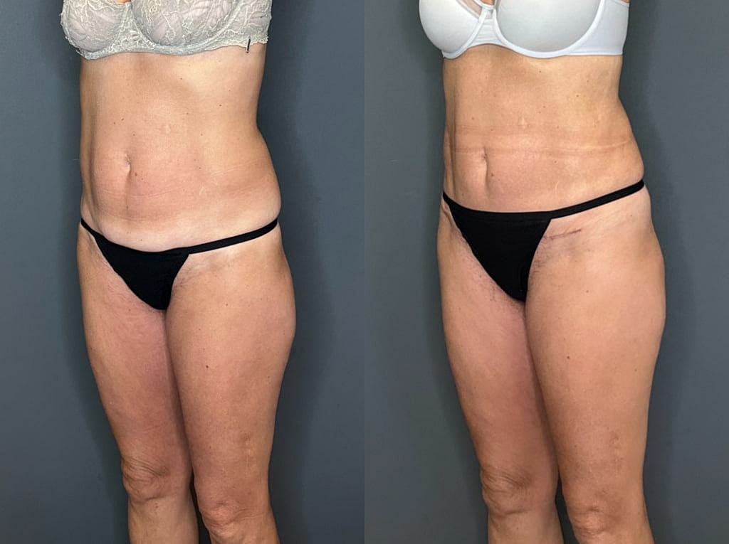 Mini Tummy Tuck Before and Afters Before & After
