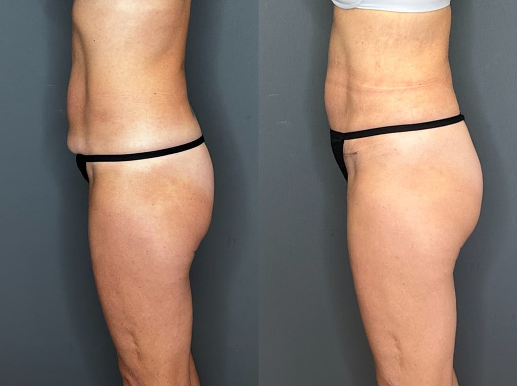 Mini Tummy Tuck Before and Afters Before & After