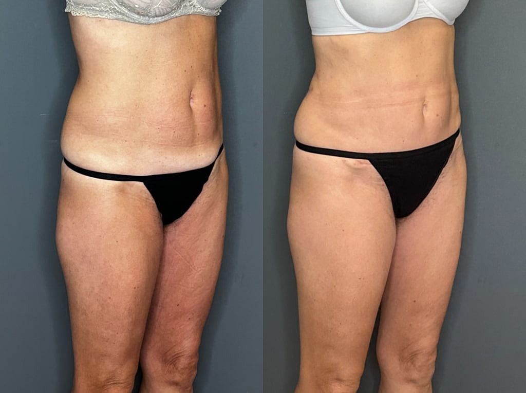 Mini Tummy Tuck Before and Afters Before & After