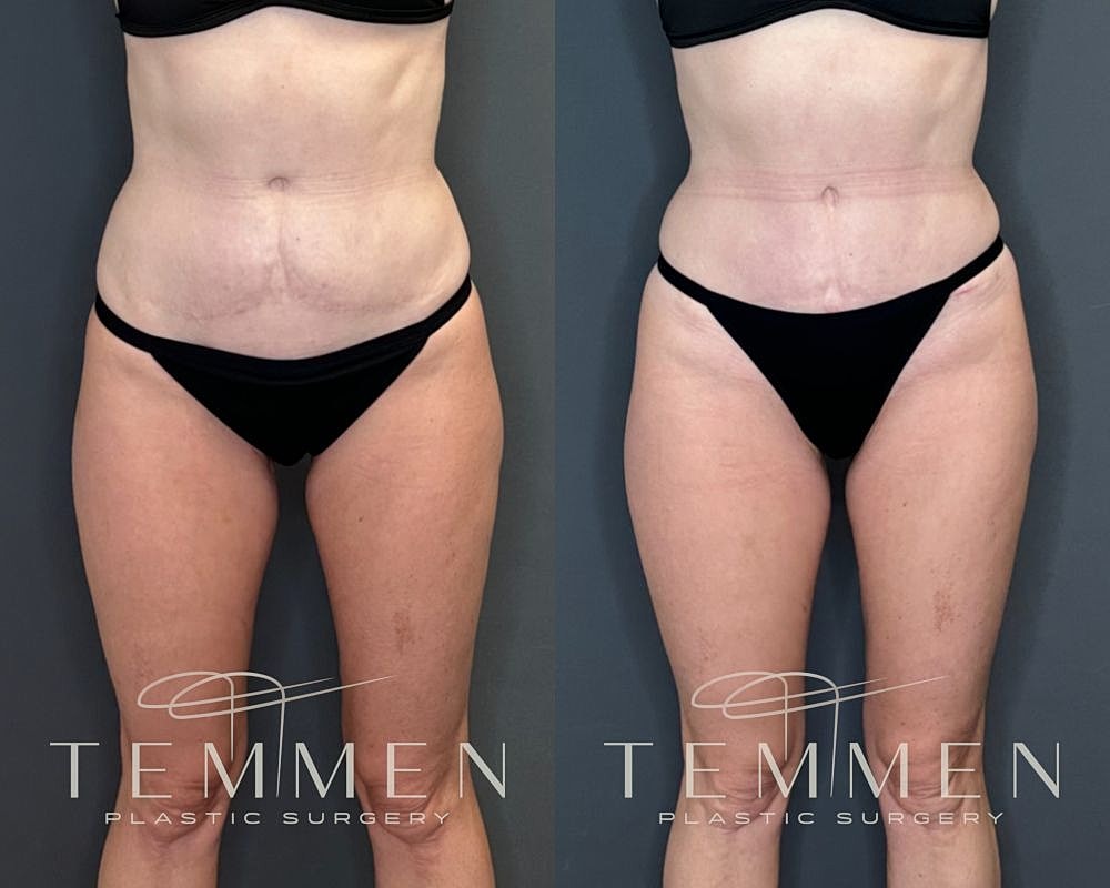 Before and after body transformation photos