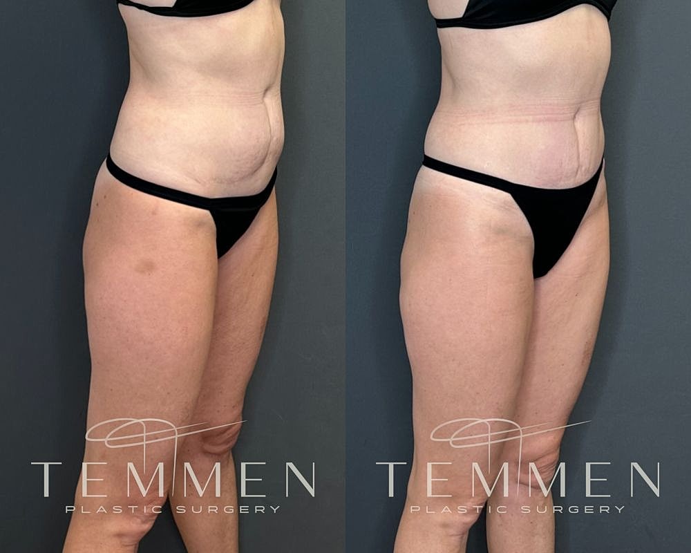Before and after body contouring transformation.