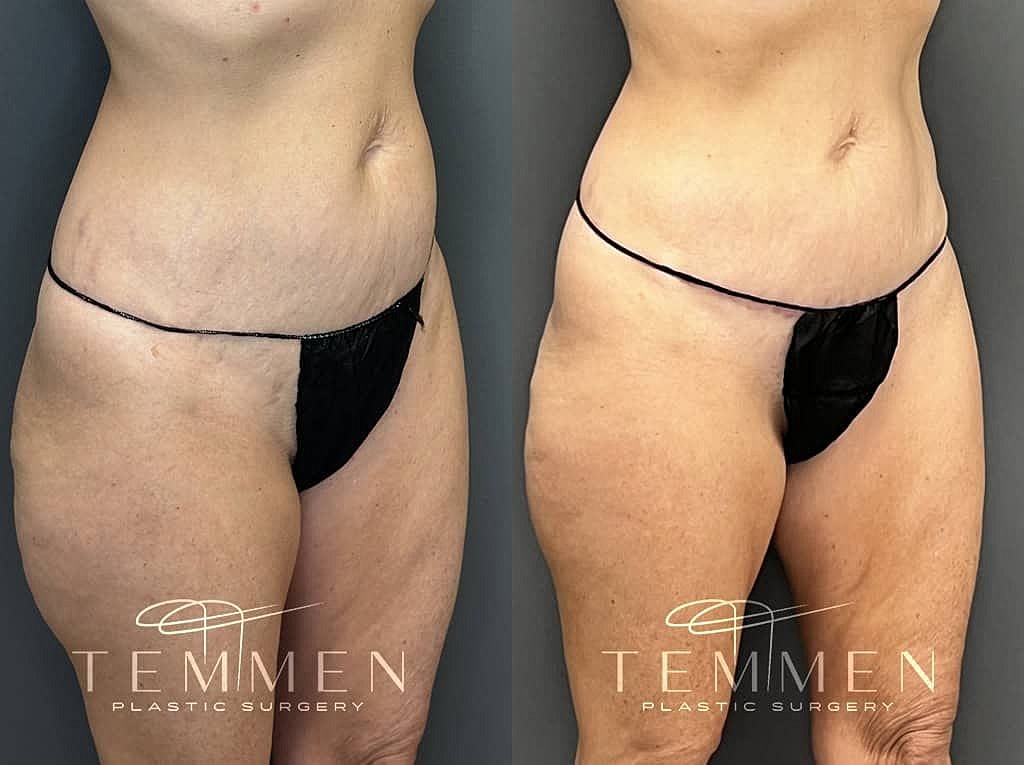 Before and after body contouring surgery comparison.