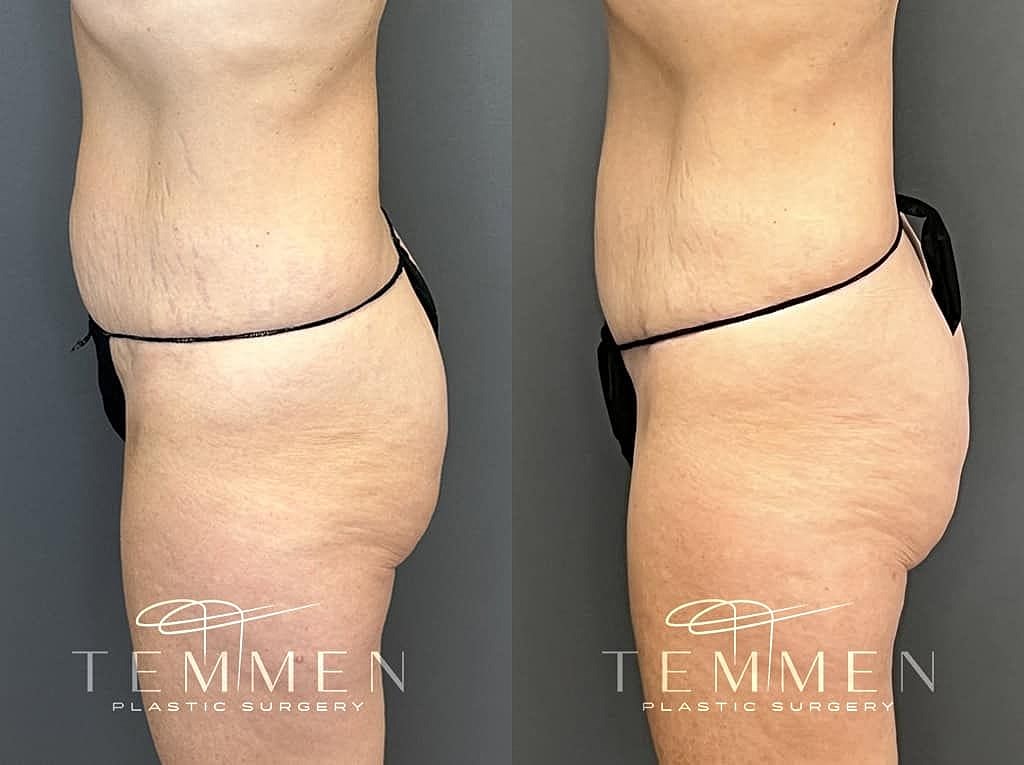 Before and after plastic surgery side view.