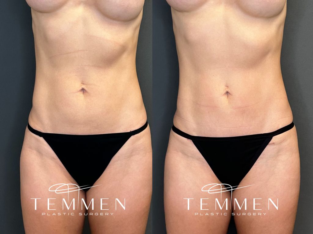 Mini Tummy Tuck Before and Afters Before & After