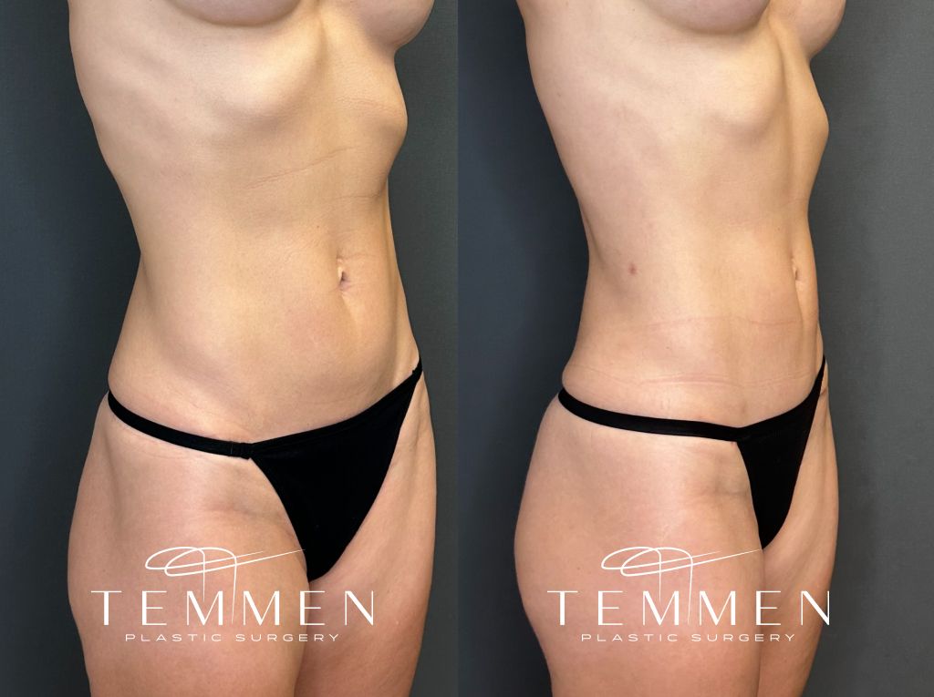 Mini Tummy Tuck Before and Afters Before & After