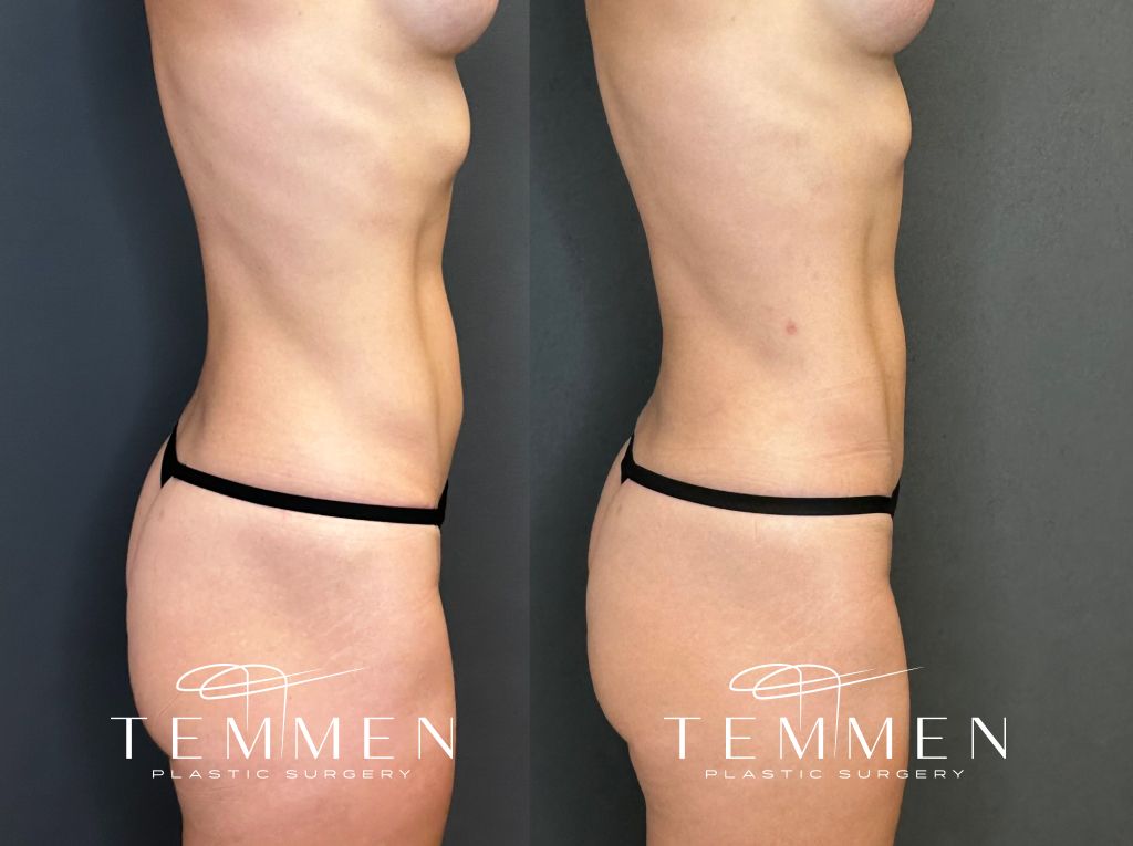 Mini Tummy Tuck Before and Afters Before & After