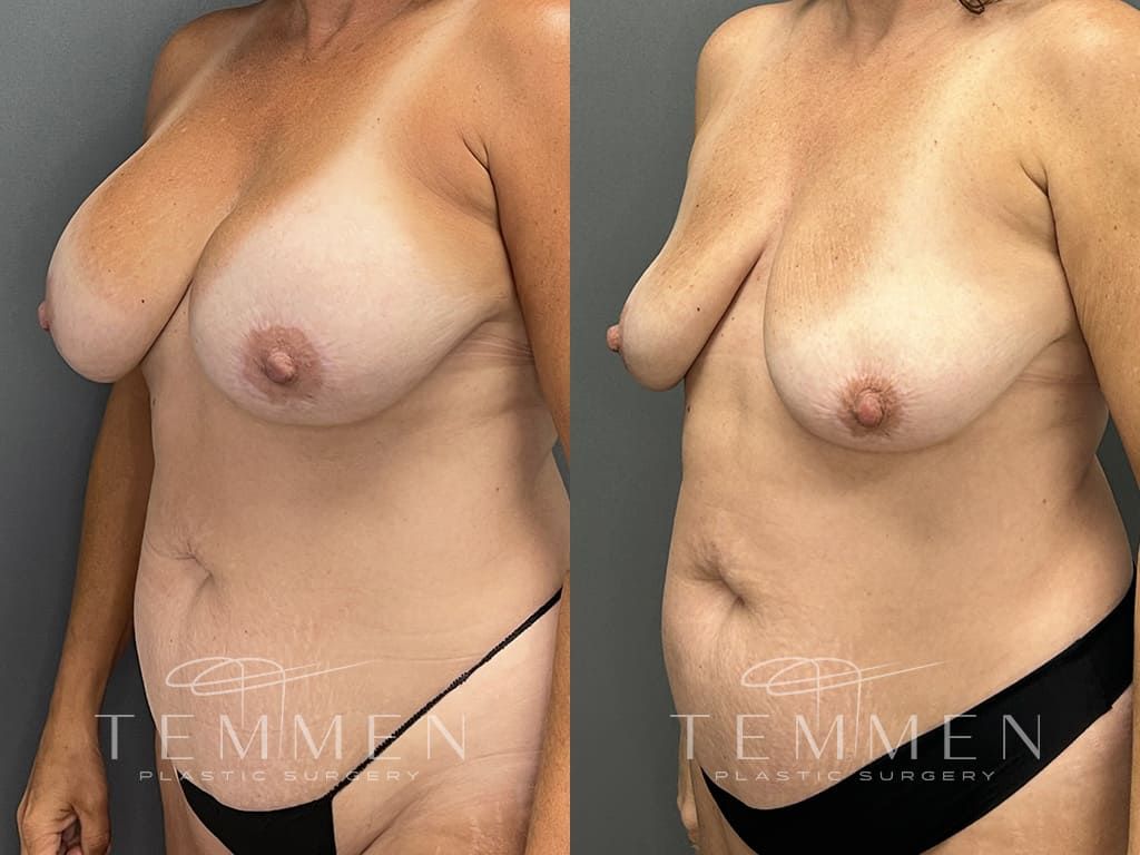 Breast Implant Removal Before & After