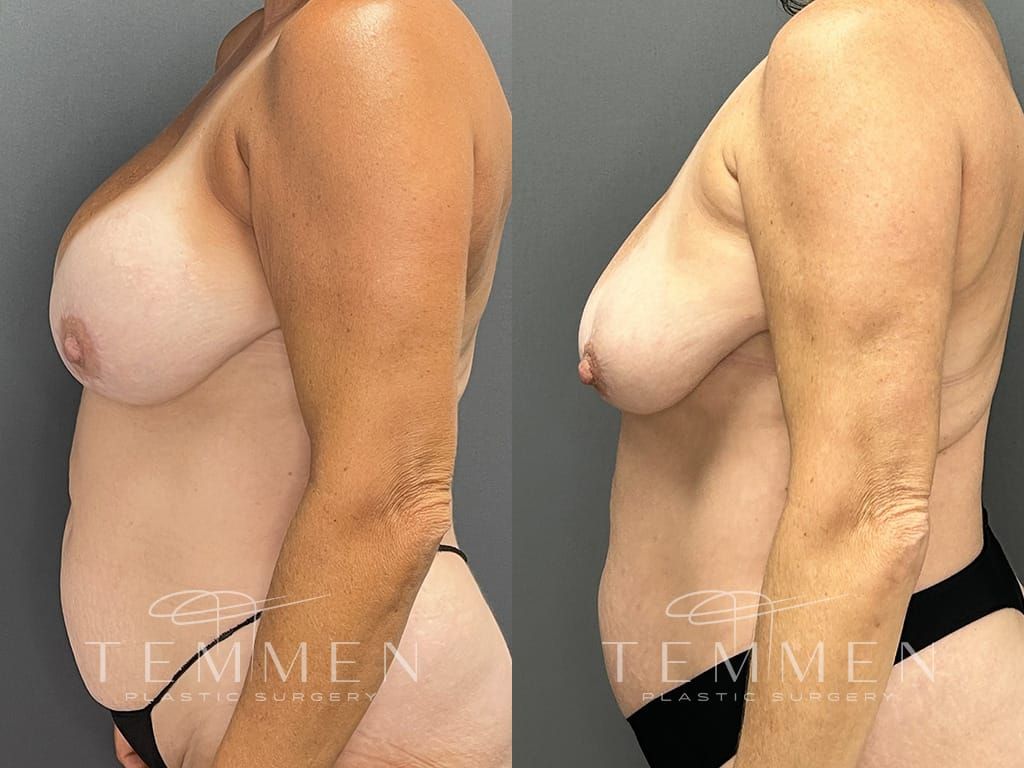 Breast Implant Removal Before & After