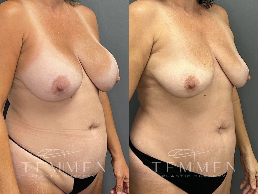 Breast Implant Removal Before & After