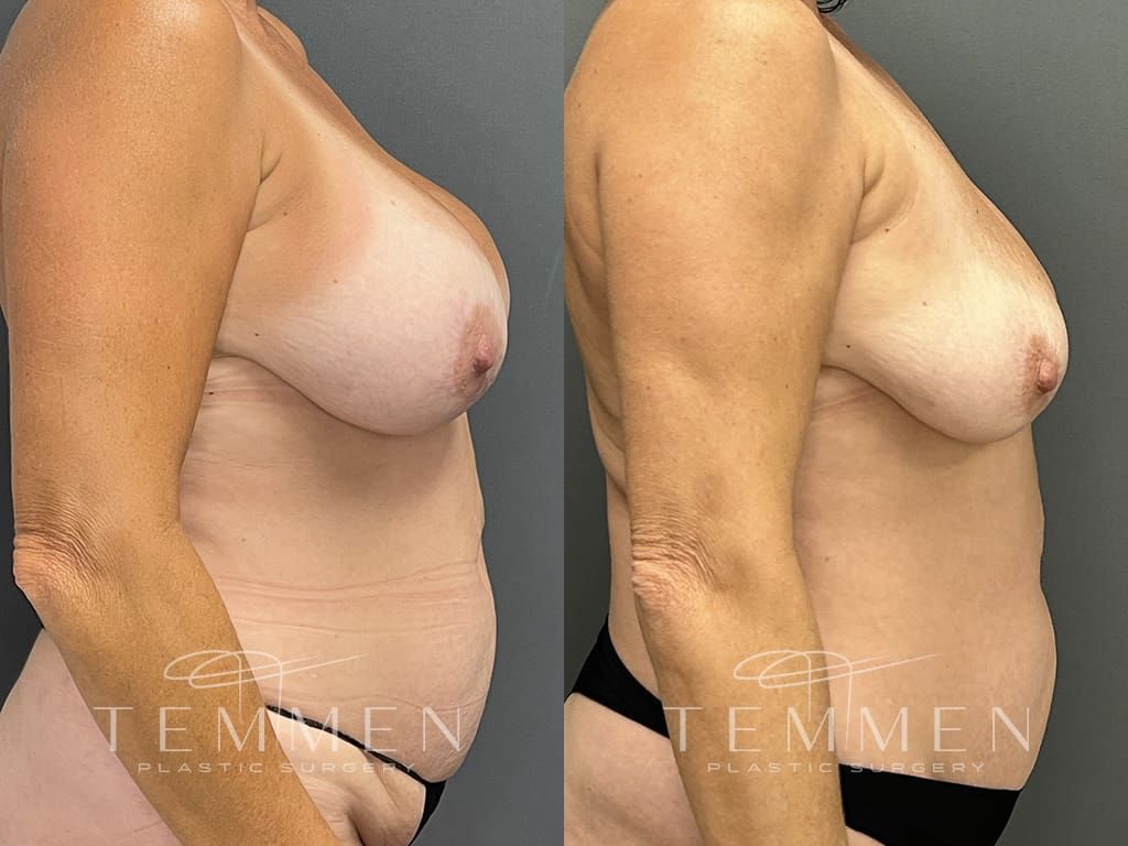 Breast Implant Removal Before & After