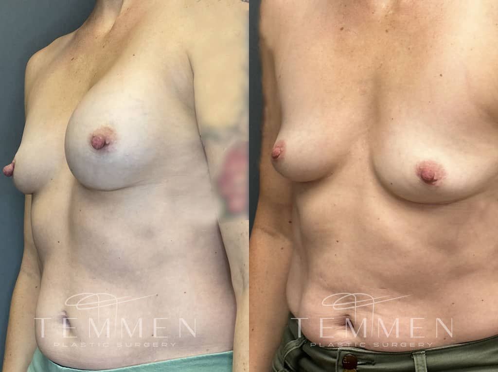 Breast Implant Removal Before & After