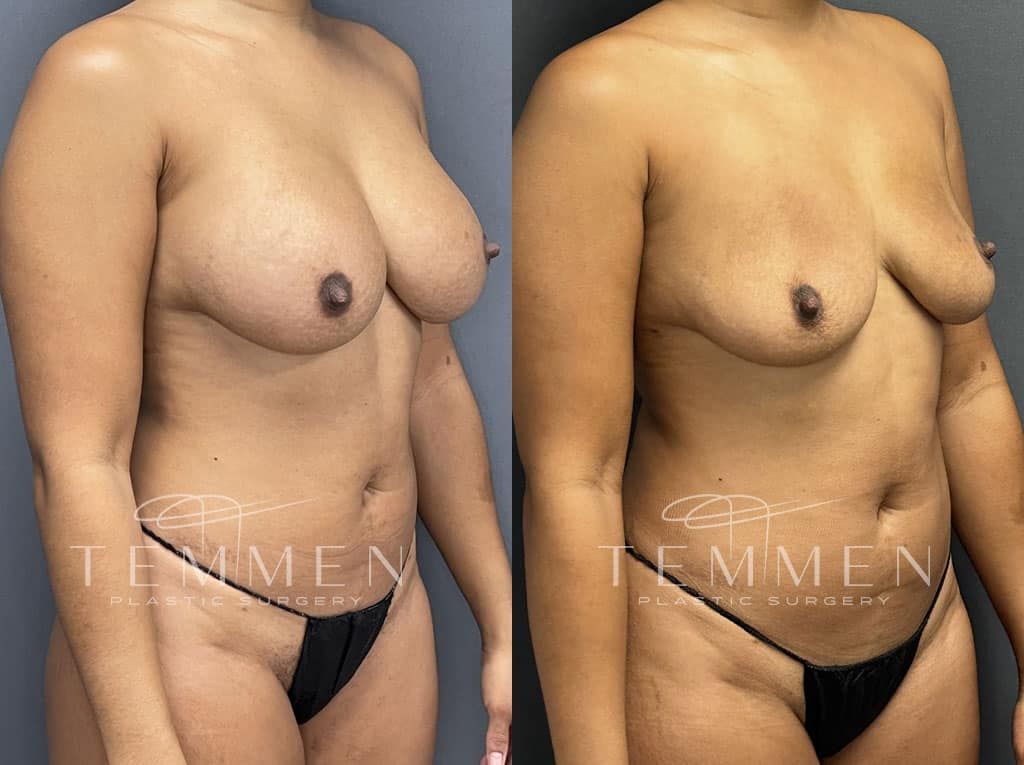 Breast Implant Removal Before & After