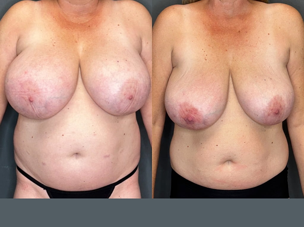 Breast Implant Removal Before & After