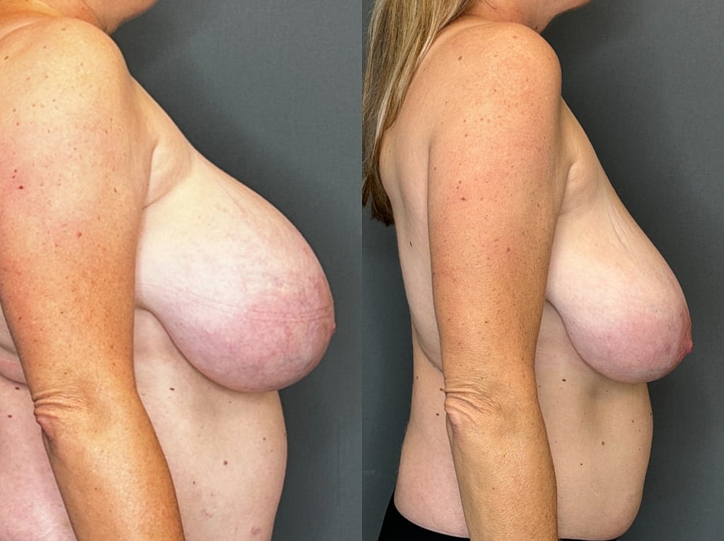 Breast Implant Removal Before & After