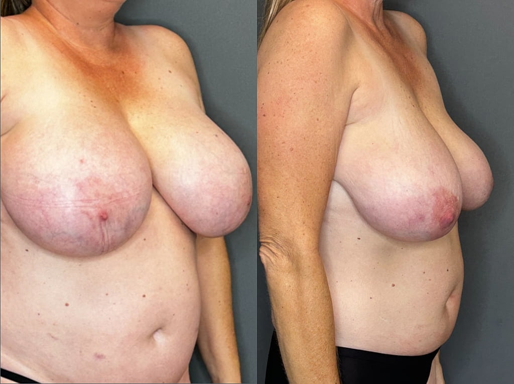 Breast Implant Removal Before & After