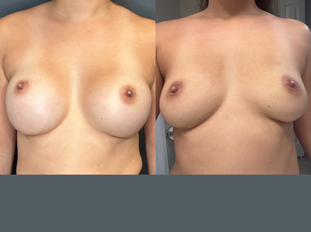Breast Implant Removal Before & After
