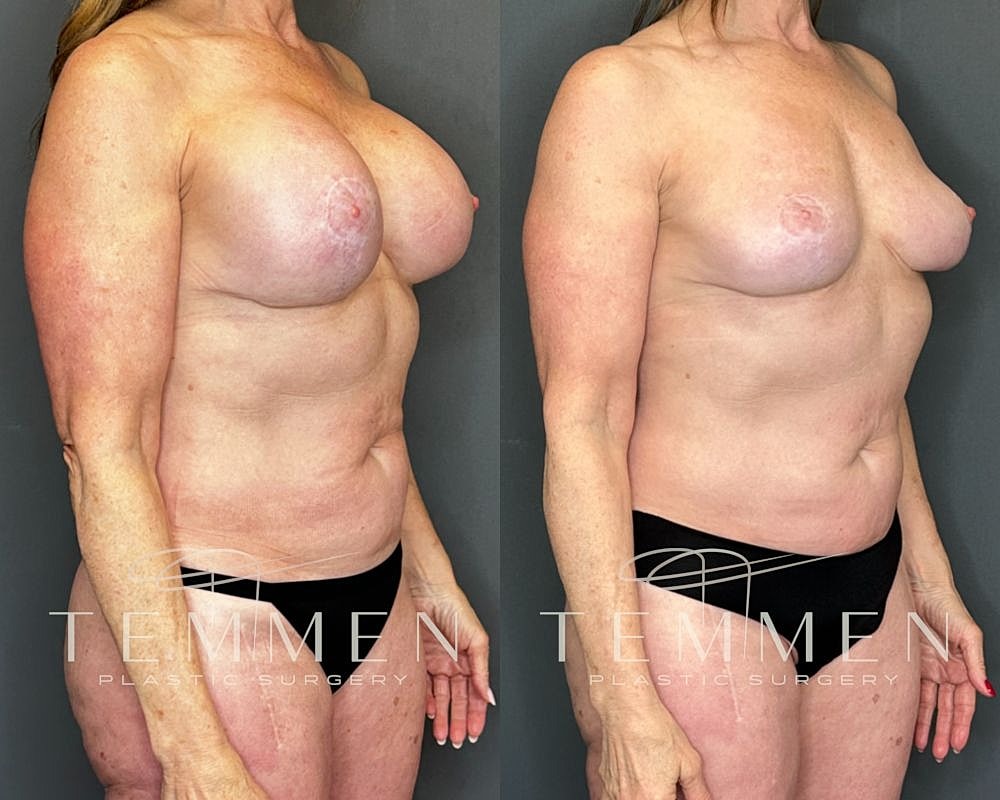 Before and after images of body contouring surgery