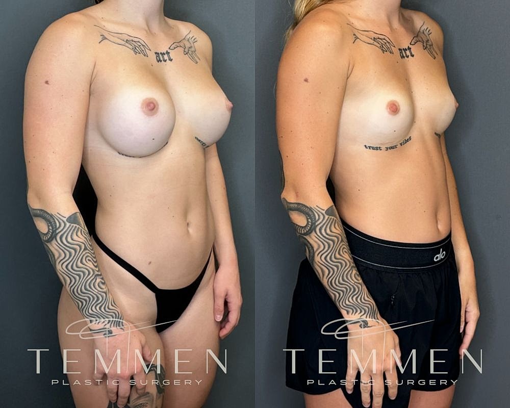 Before and after breast augmentation result.