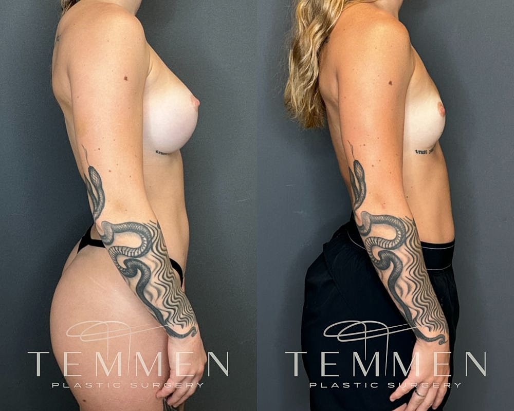 Before and after cosmetic surgery comparison image.