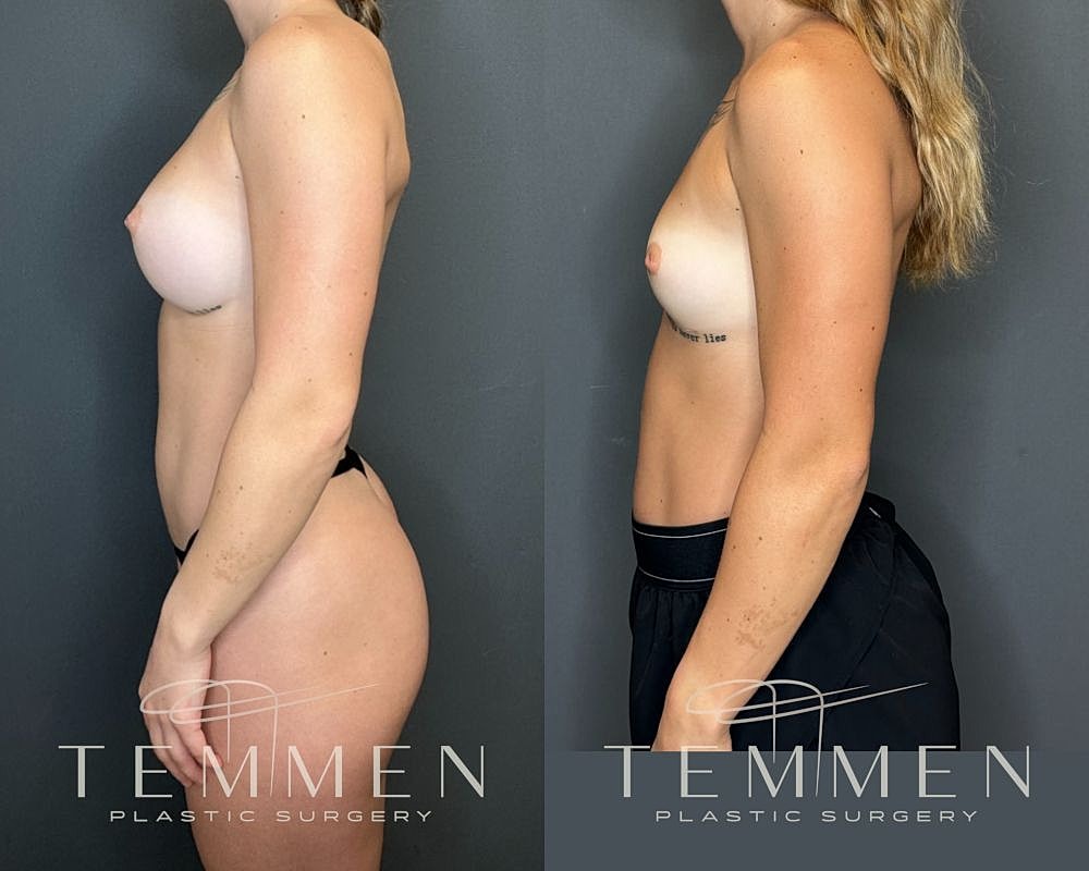 Before and after plastic surgery side profile.