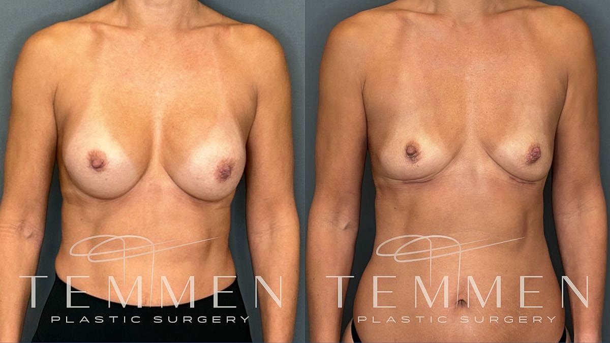Breast Implant Removal Before & After