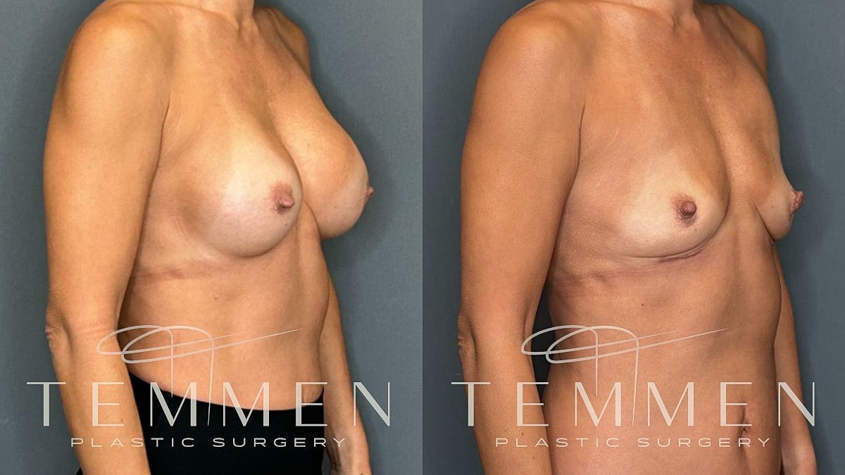 Breast Implant Removal Before & After