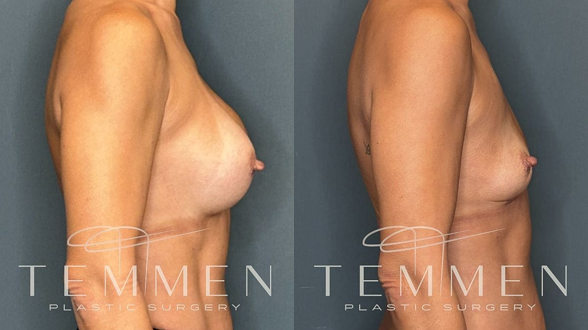 Breast Implant Removal Before & After