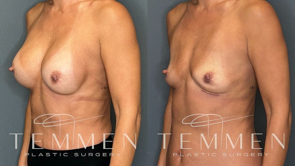 Breast Implant Removal Before & After