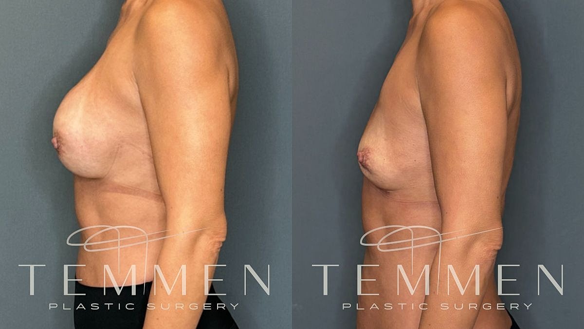 Breast Implant Removal Before & After