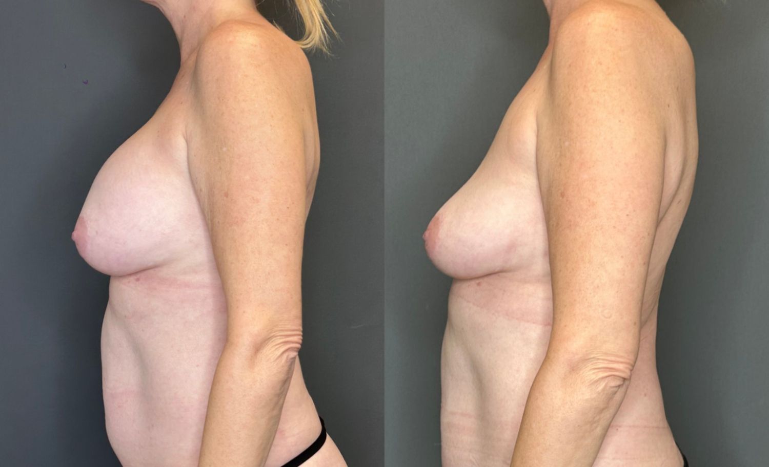 Breast Implant Removal Before & After
