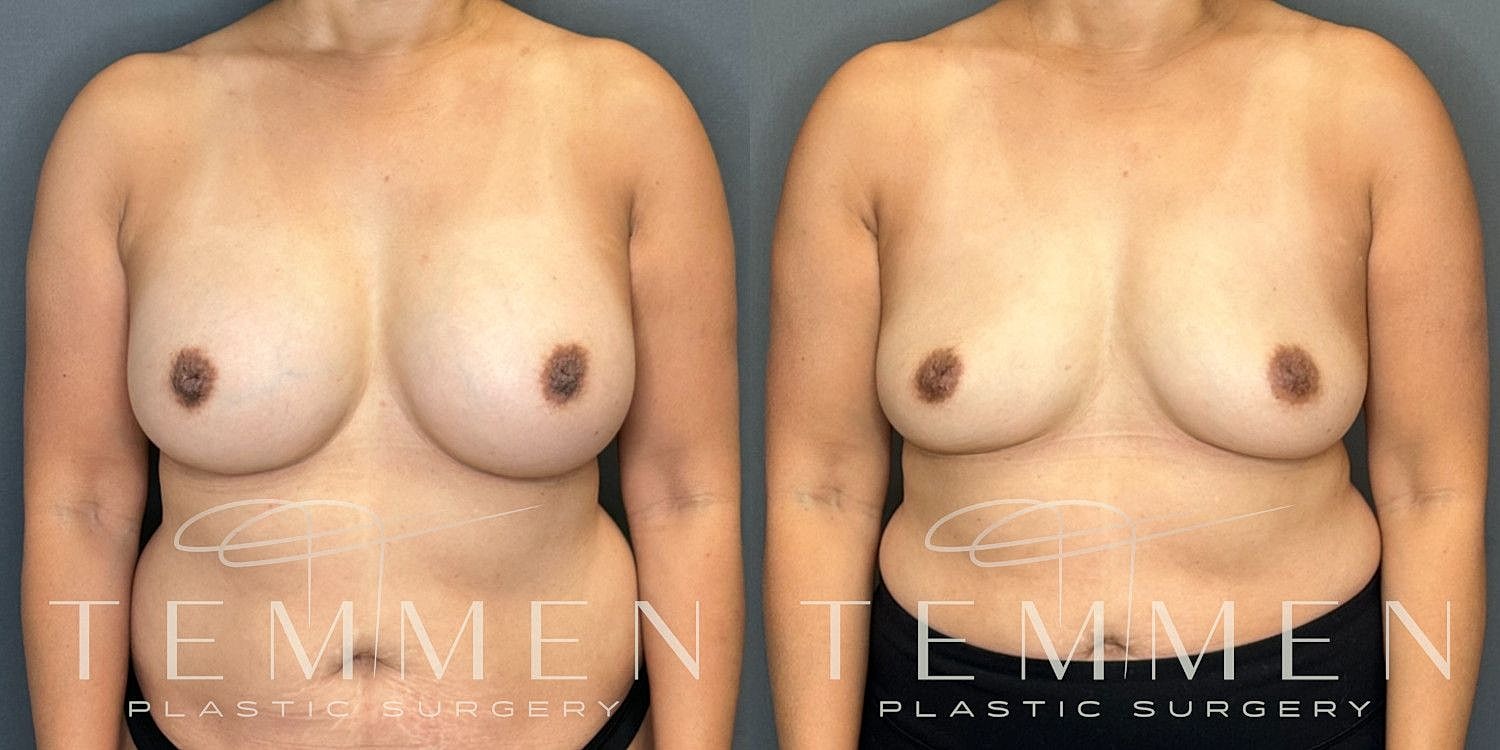Breast Implant Removal Before & After