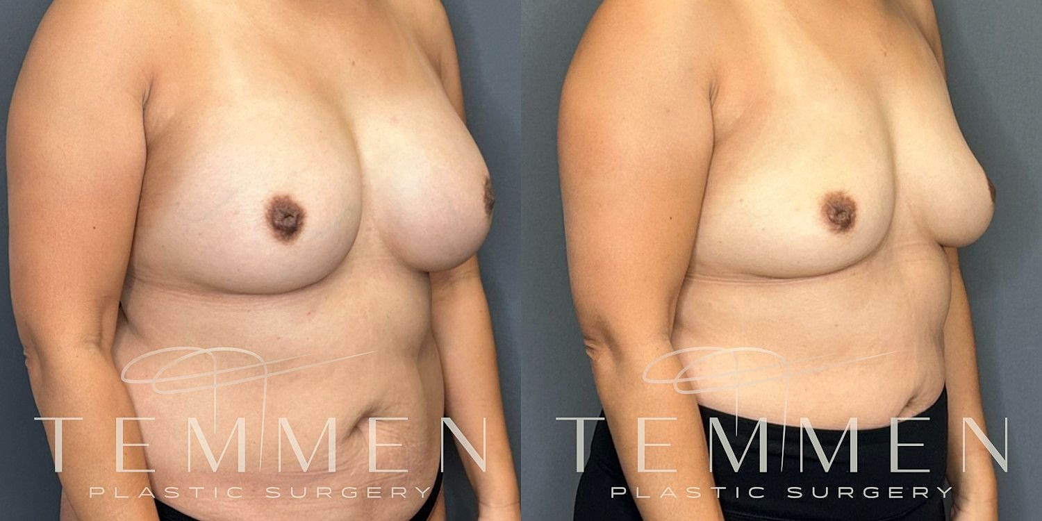 Breast Implant Removal Before & After