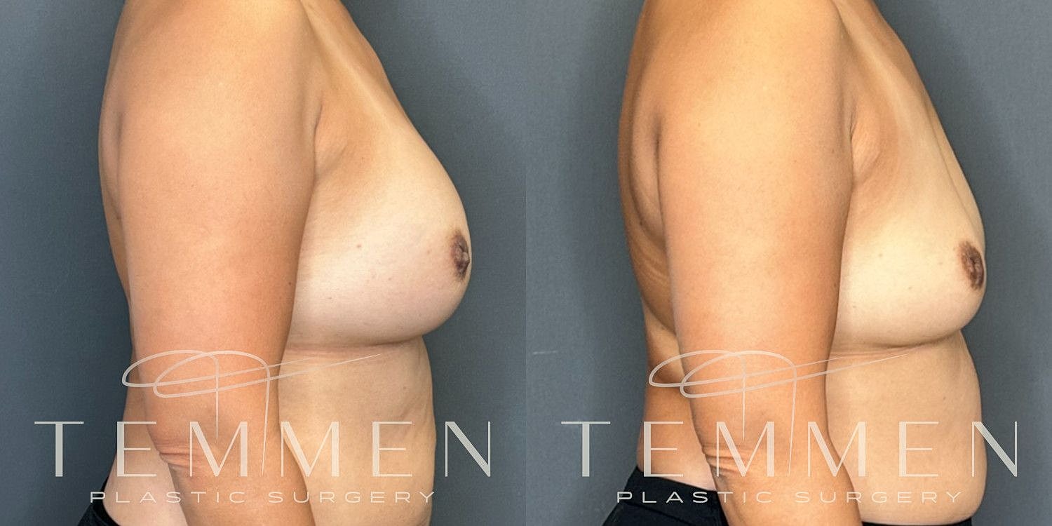 Breast Implant Removal Before & After