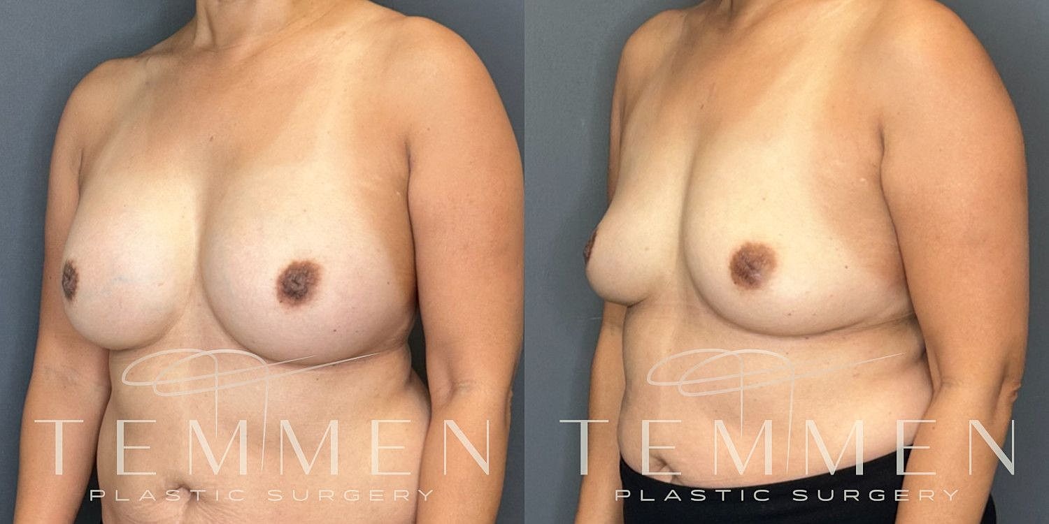 Breast Implant Removal Before & After