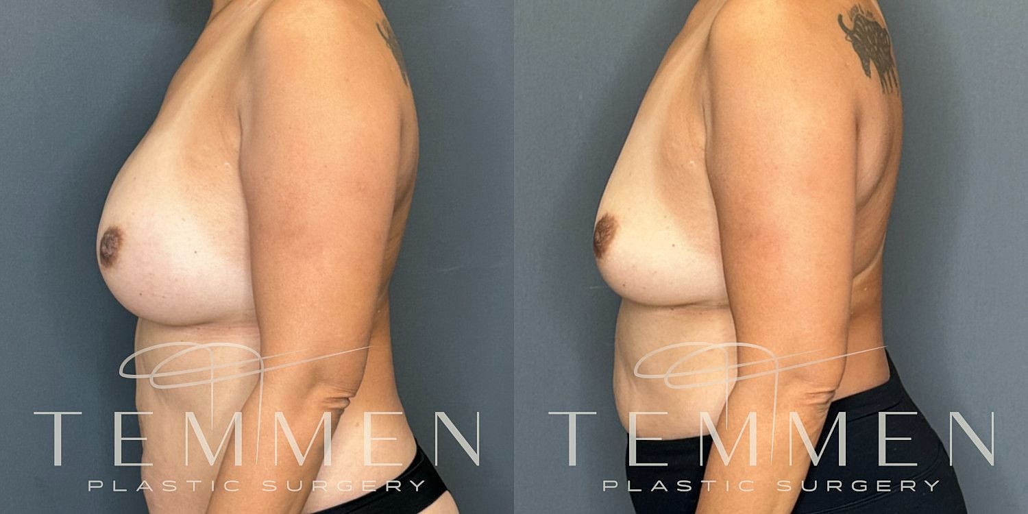 Breast Implant Removal Before & After