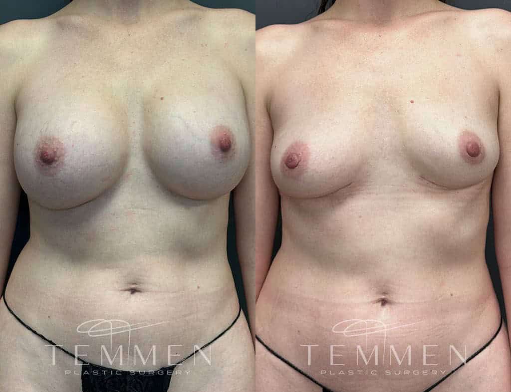 Breast Implant Removal Before & After