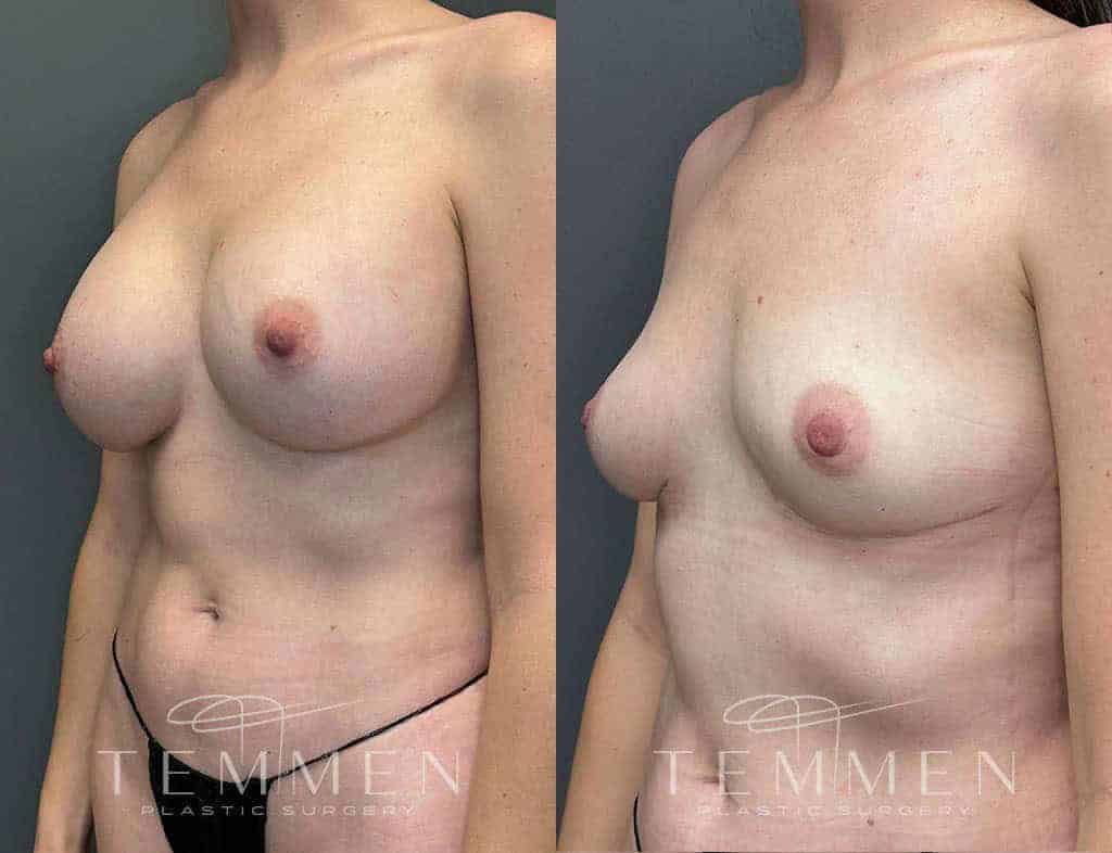 Breast Implant Removal Before & After